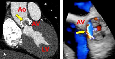 Utility of Plasma Microbial Cell-Free DNA Decay Kinetics After Aortic Valve Replacement for Bartonella Endocarditis: Case Report